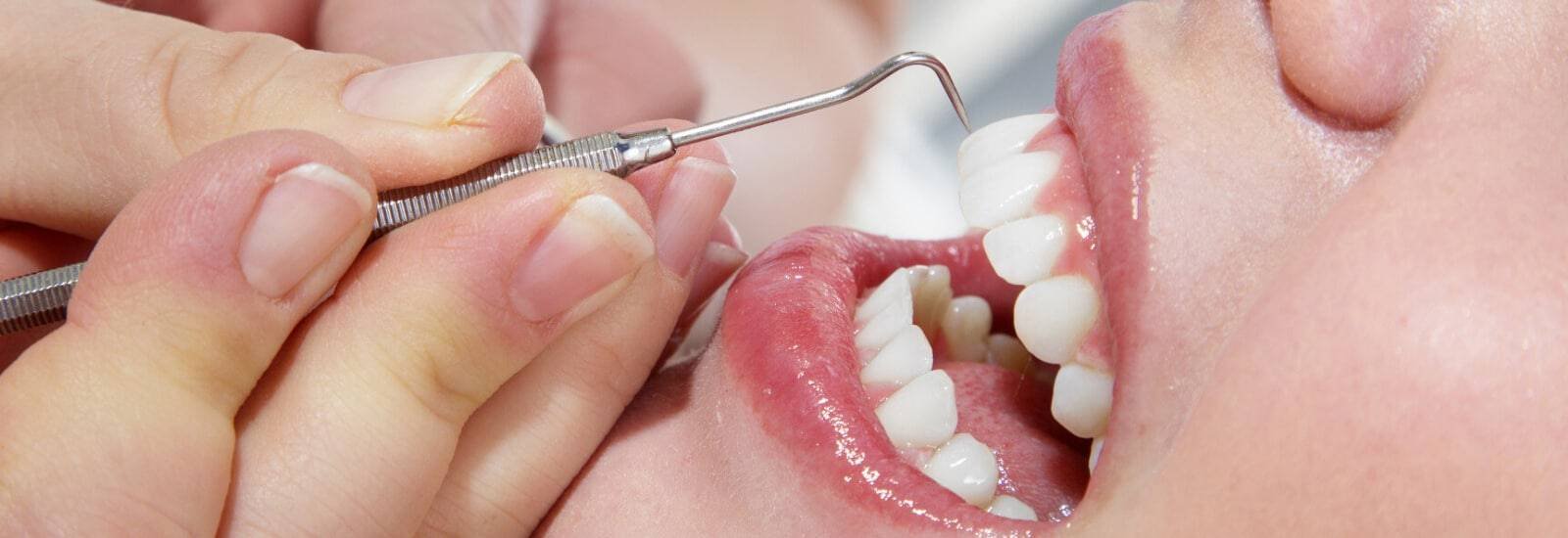 Teeth Cleaning